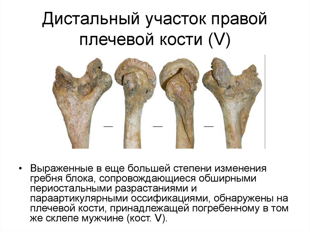 Bone 5. Дистальный конец плечевой кости. Гипертрофическая остеоартропатия.