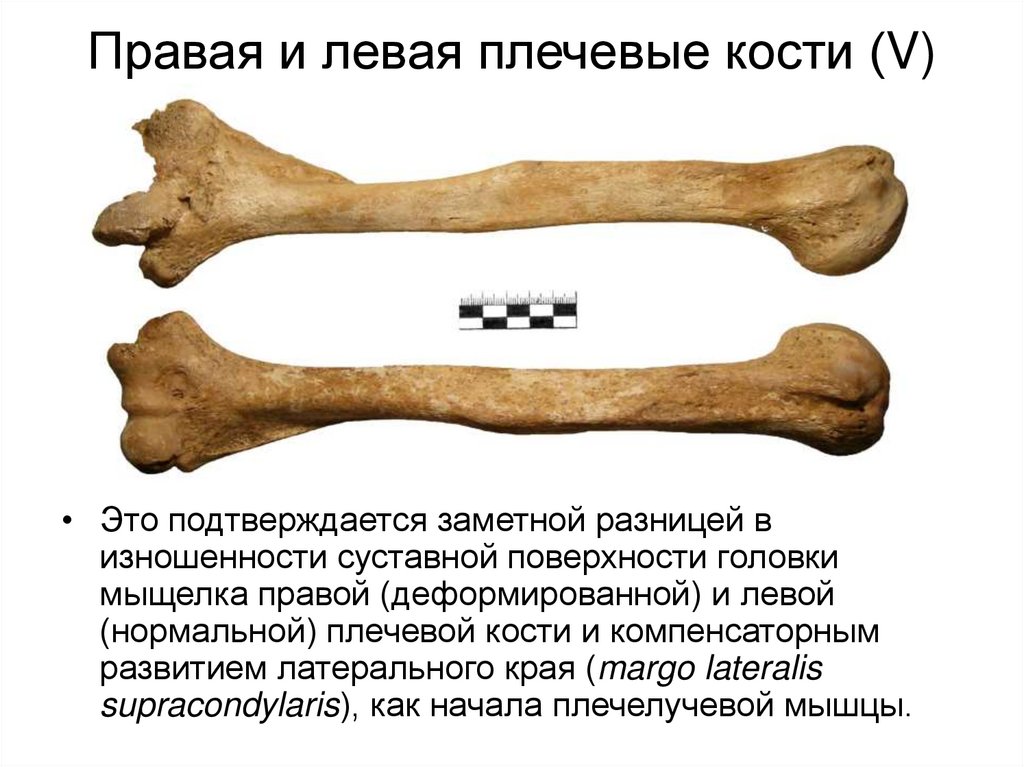 Bone 5. Левая плечевая кость. Плечевая кость мыщелки. Мыщелок плечевой кости.