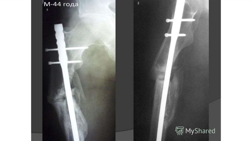 Переломы бедра презентация