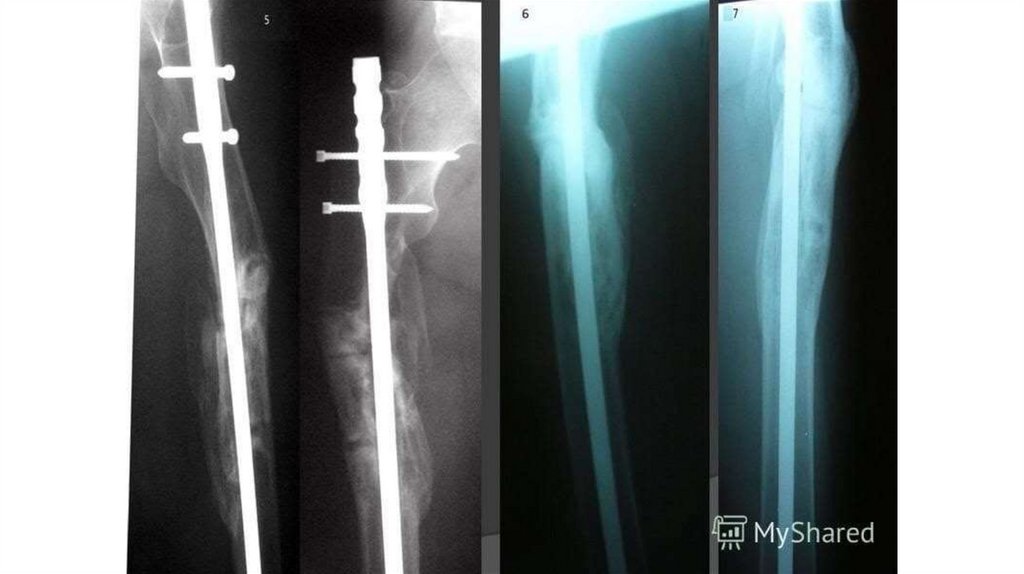 Переломы бедра презентация