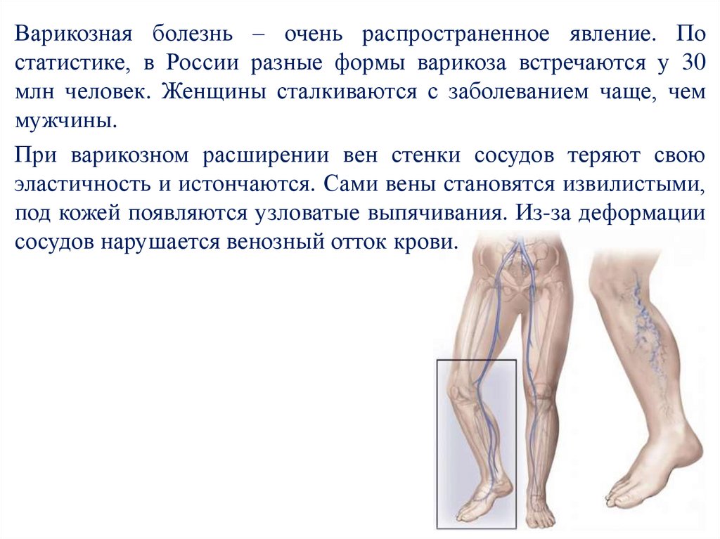 Венозное расширение вен - презентация онлайн
