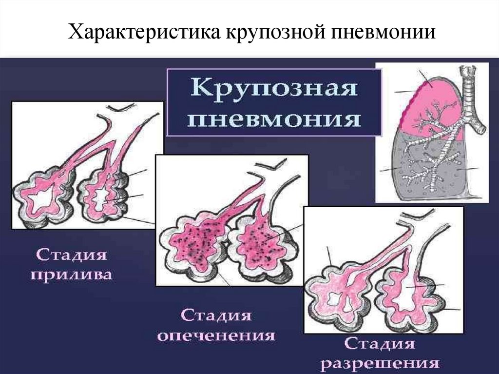 Стадии пневмонии