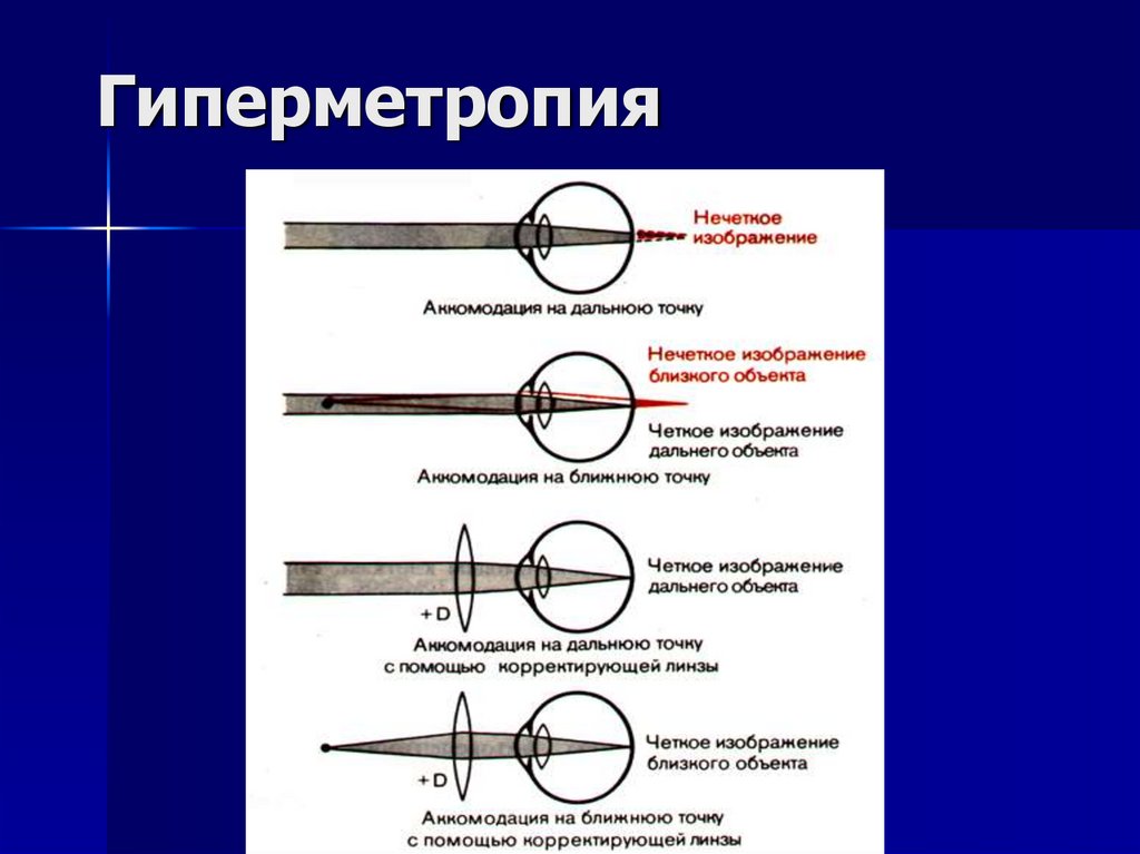 Гиперметропия что это такое