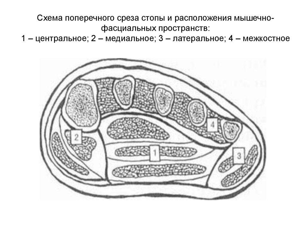 Схема поперечного среза стопы и расположения мышечно-фасциальных пространств: 1 – центральное; 2 – медиальное; 3 – латеральное;