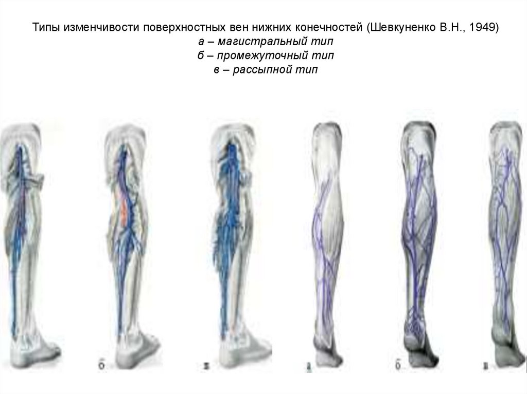 Типы изменчивости поверхностных вен нижних конечностей (Шевкуненко В.Н., 1949) а – магистральный тип б – промежуточный тип в –