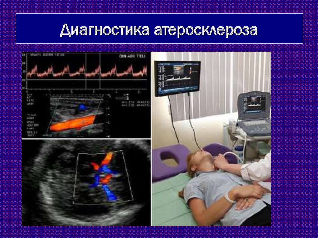 Узи атеросклероз. Диагностика атеросклероза. Методы исследования атеросклероза. Диагностирование атеросклероза. Инструментальные исследования при атеросклерозе.