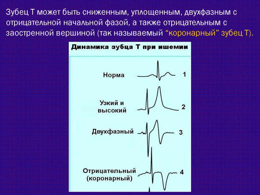 Сестринский процесс при стенокардии