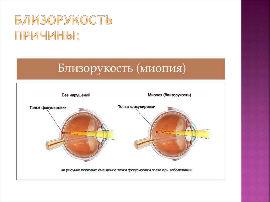 Зрение история болезни