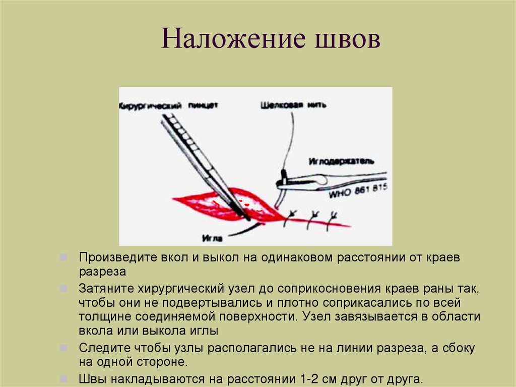 Ли шов. Наложение швов на рану алгоритм.