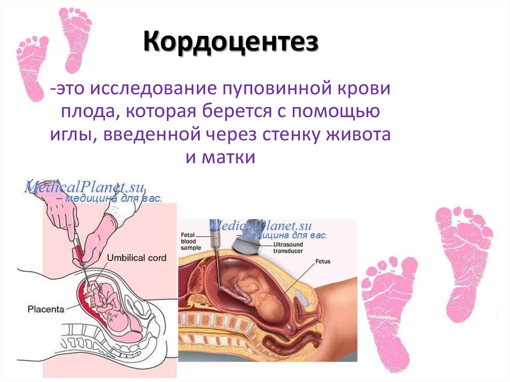 Кордоцентез
