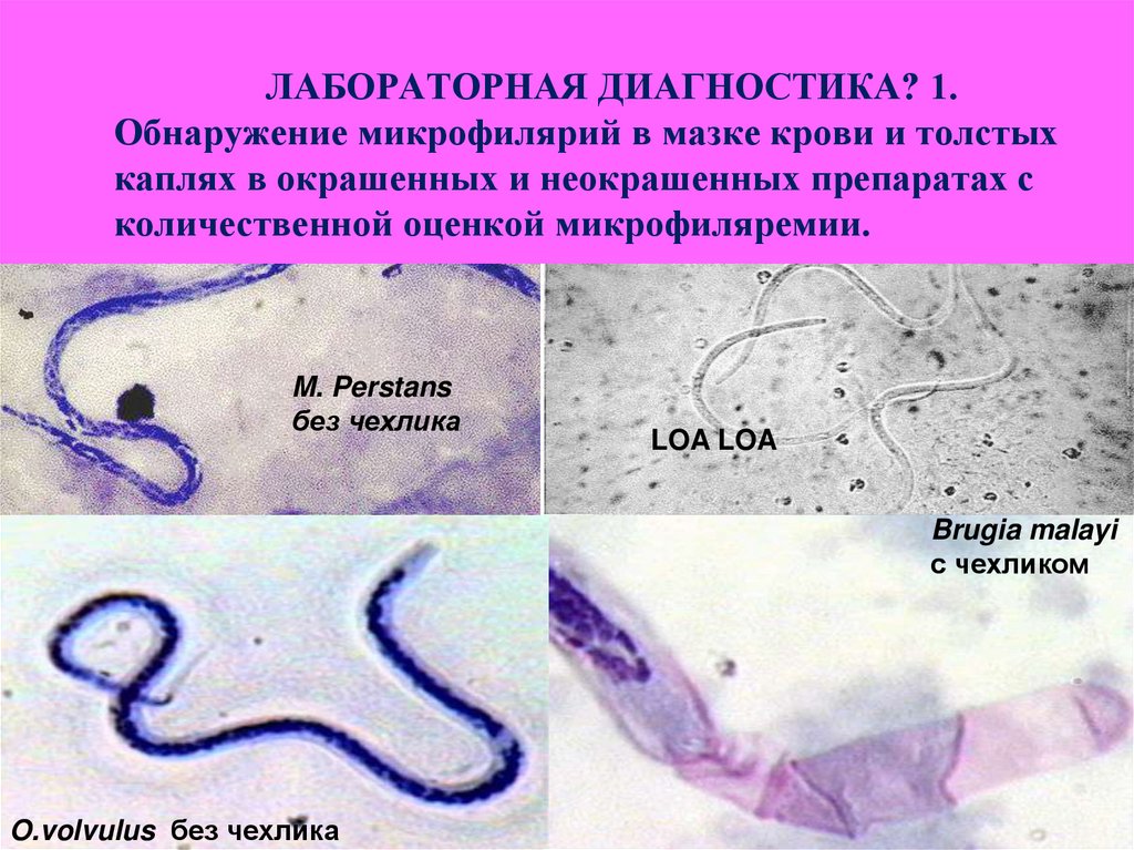ЛАБОРАТОРНАЯ ДИАГНОСТИКА? 1. Обнаружение микрофилярий в мазке крови и толстых каплях в окрашенных и неокрашенных препаратах с