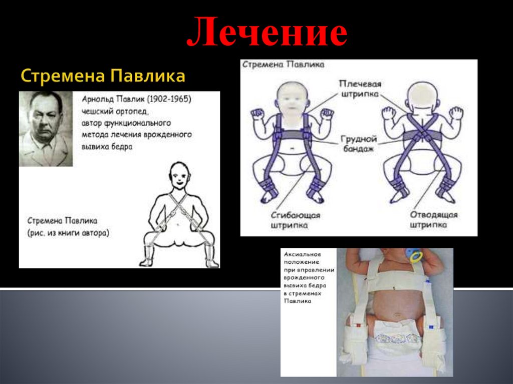 Врожденный вывих бедра. Симптомы врожденного вывиха бедра. Клинические проявления врожденного вывиха бедра. Врожденный вывих бедра этиология. Врожденная деформация бедра.