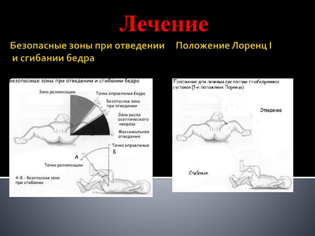Безопасные зоны при отведении Положение Лоренц I и сгибании бедра