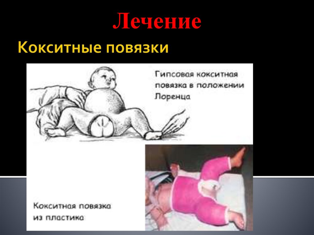 Кокситные повязки