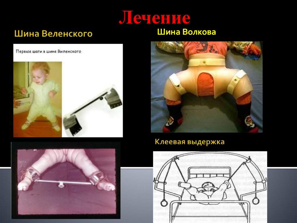 Шина Веленского Клеевая выдержка