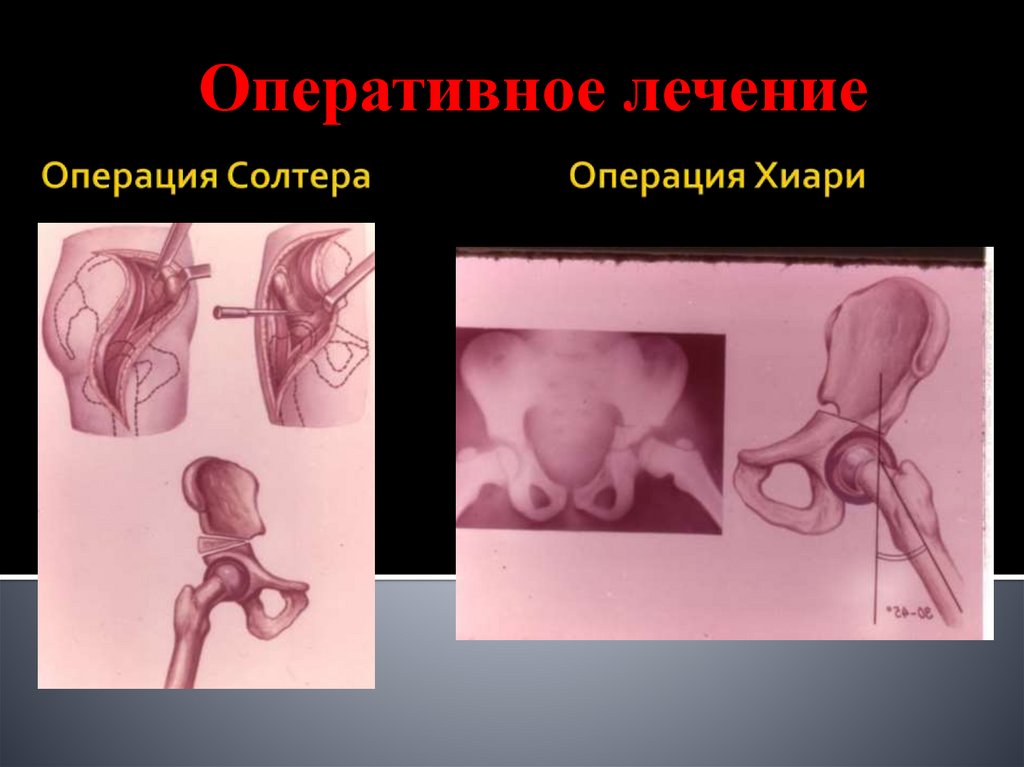 Операция Солтера Операция Хиари