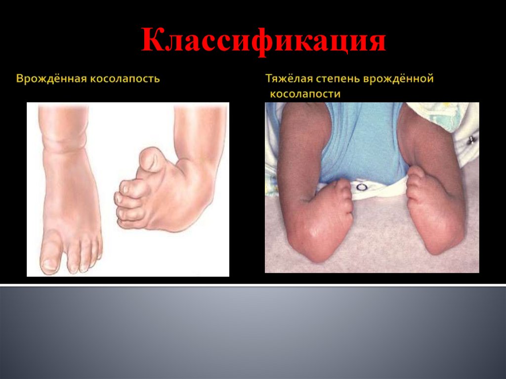 Врождённая косолапость Тяжёлая степень врождённой косолапости