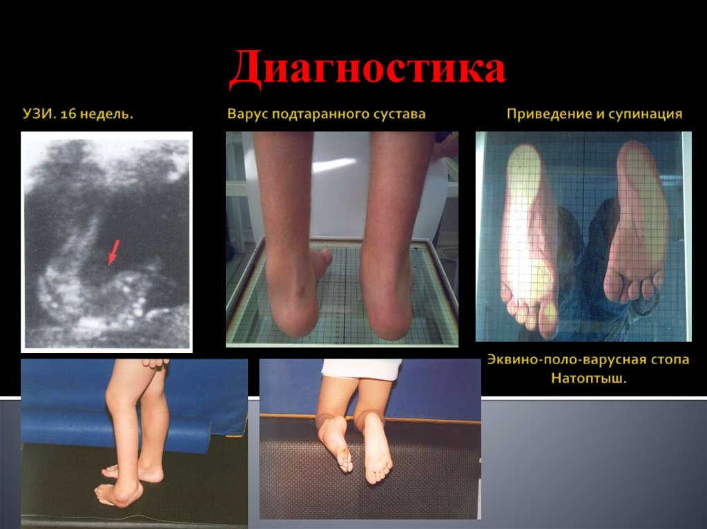 УЗИ. 16 недель. Варус подтаранного сустава Приведение и супинация Эквино-поло-варусная стопа Натоптыш.