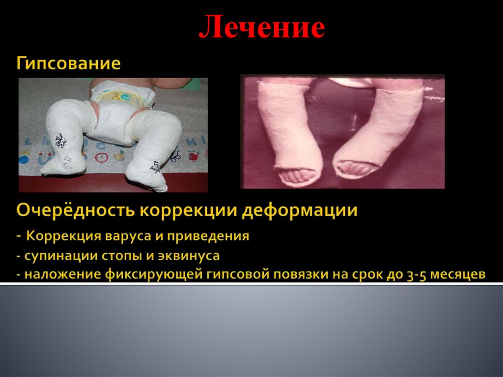 Гипсование Очерёдность коррекции деформации - Коррекция варуса и приведения - супинации стопы и эквинуса - наложение