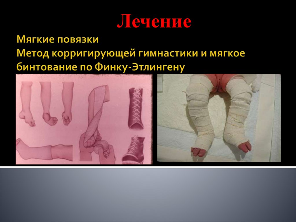 Мягкие повязки Метод корригирующей гимнастики и мягкое бинтование по Финку-Этлингену