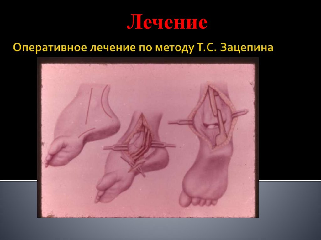 Оперативное лечение по методу Т.С. Зацепина