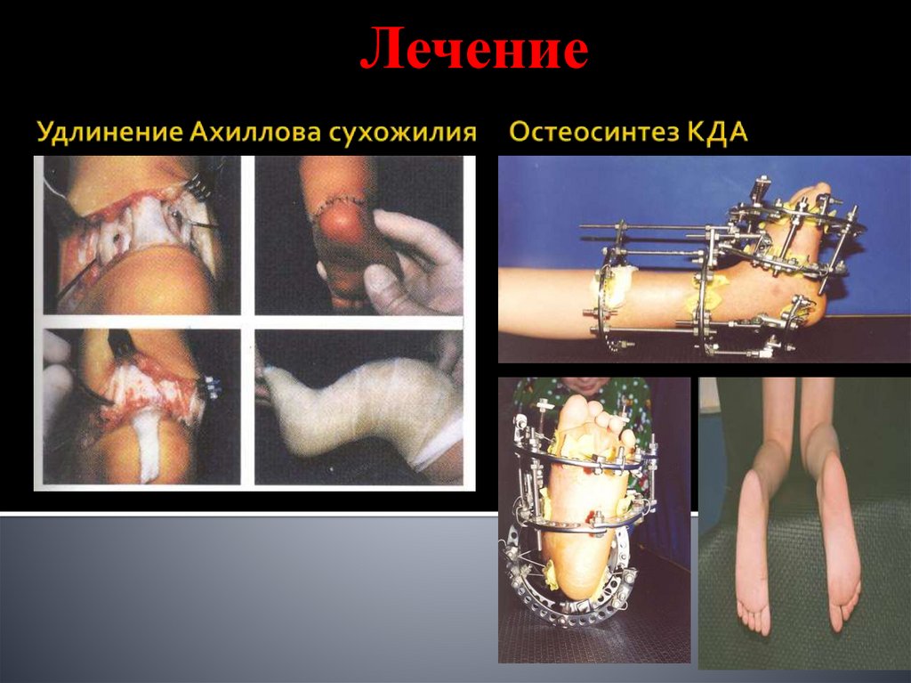 Удлинение Ахиллова сухожилия Остеосинтез КДА
