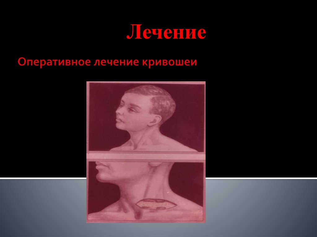 Оперативное лечение кривошеи