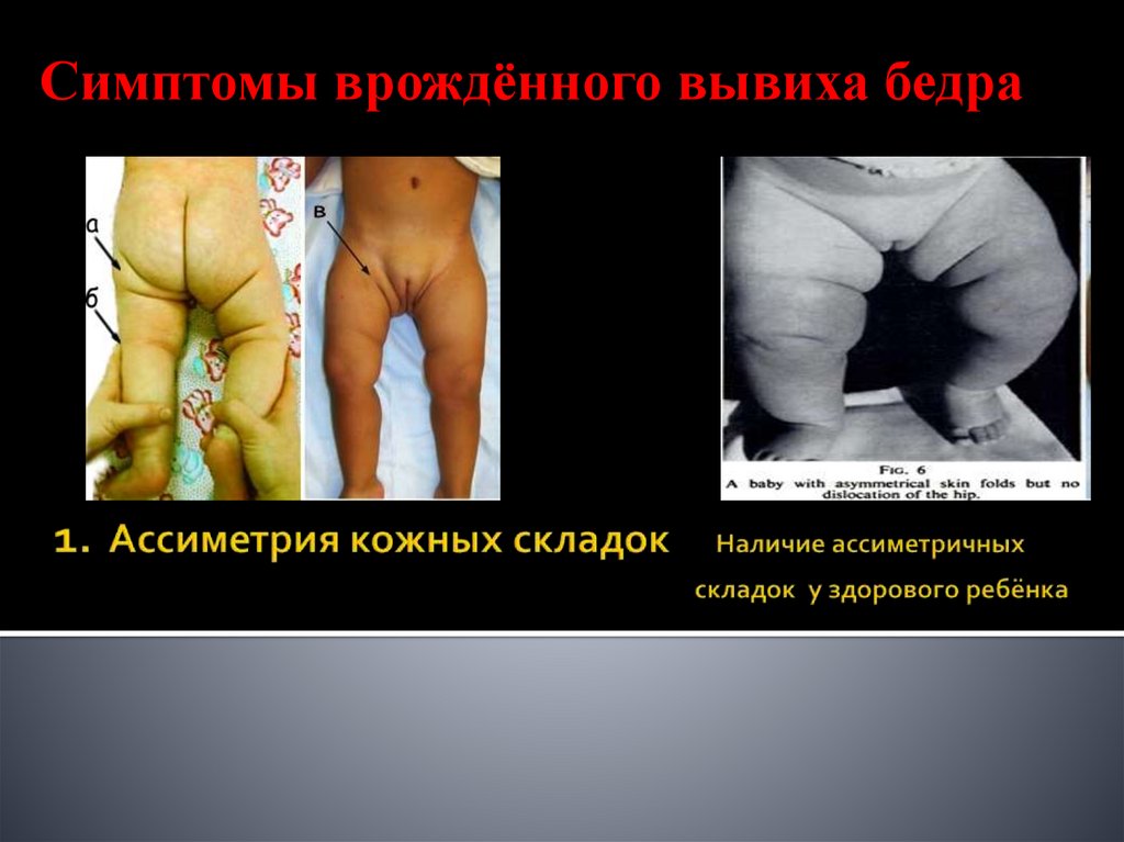 1. Ассиметрия кожных складок Наличие ассиметричных складок у здорового ребёнка