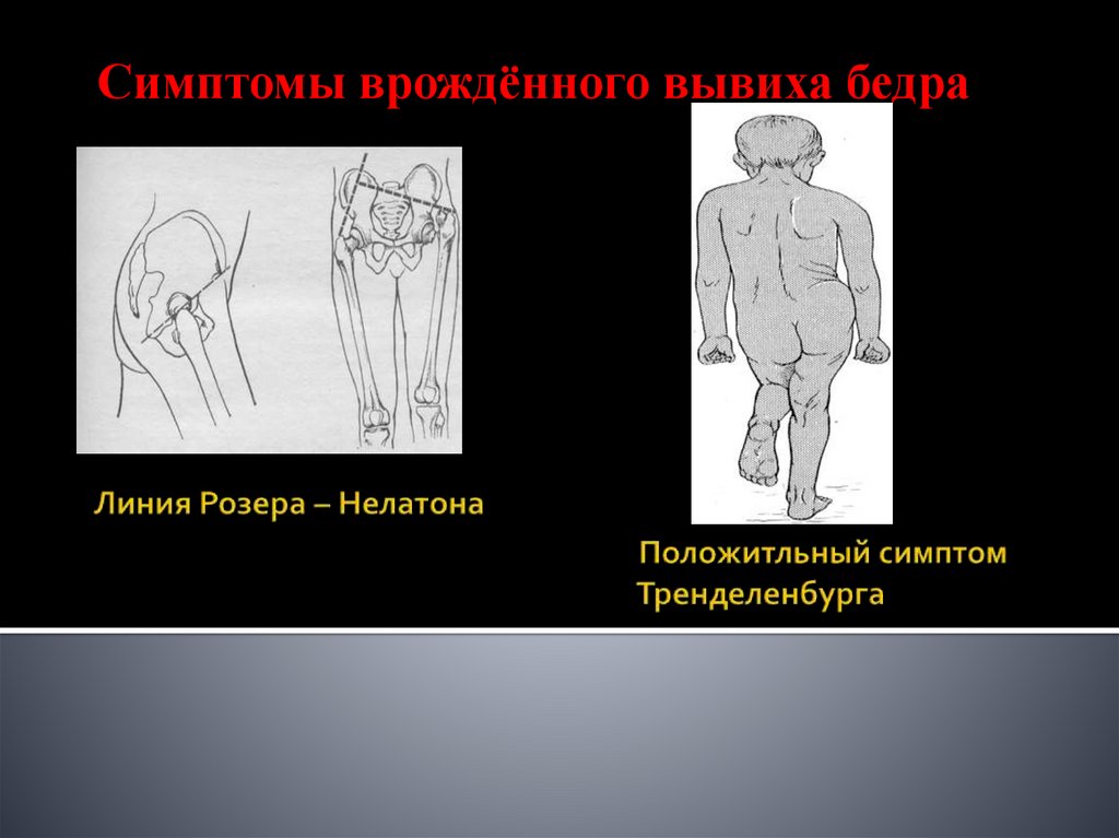 Для клинической картины врожденного вывиха бедра характерны симптомы