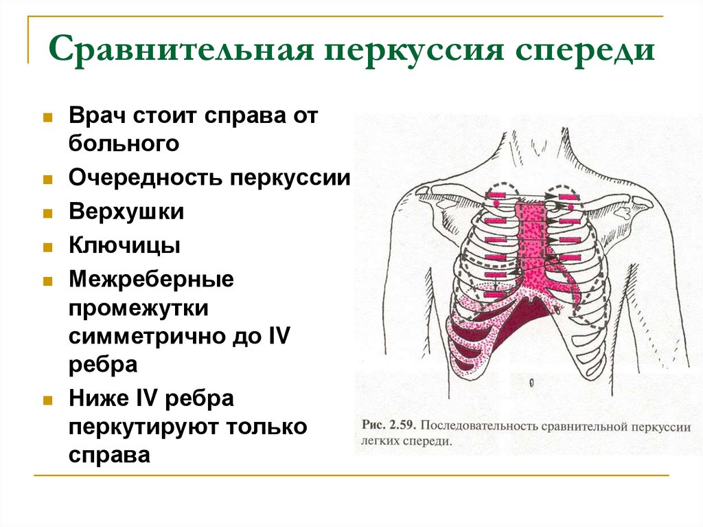 Перкуссия легких схема