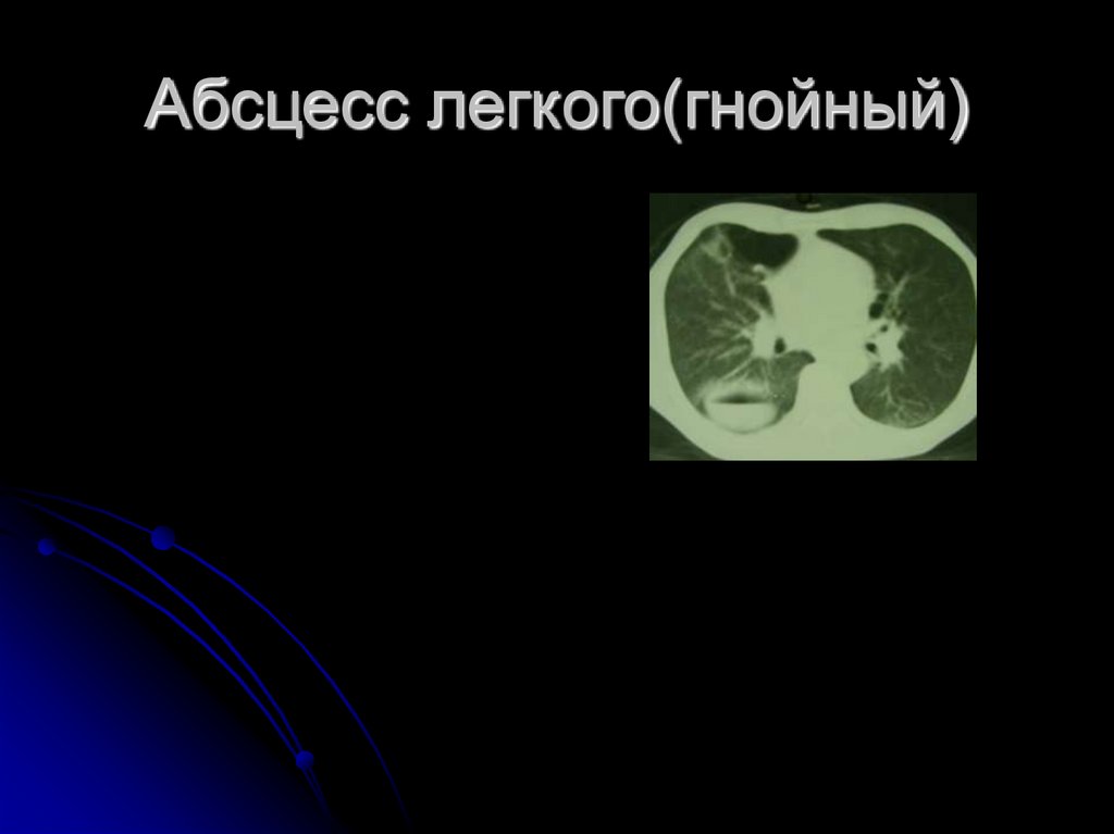Абсцесс легкого(гнойный)