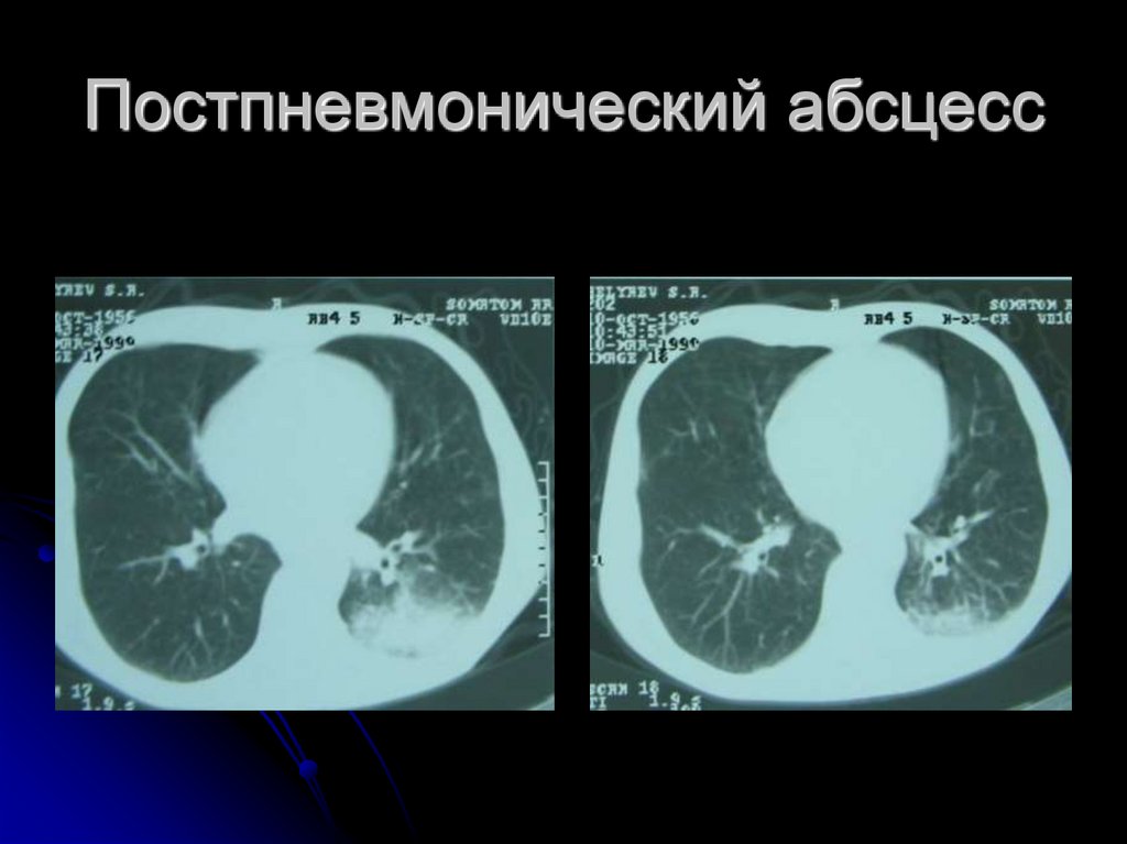 Постпневмонический абсцесс