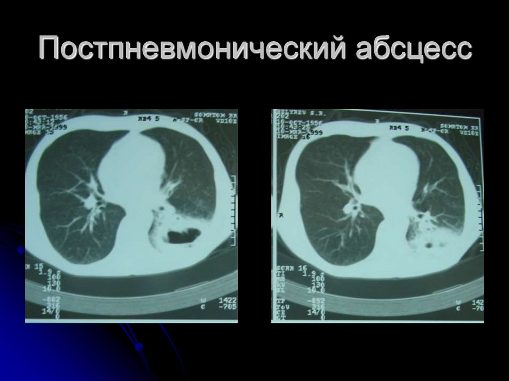 Постпневмонический абсцесс