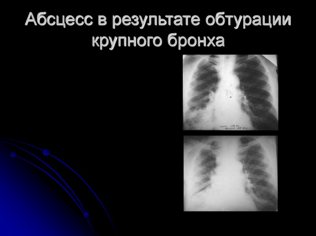 Абсцесс в результате обтурации крупного бронха