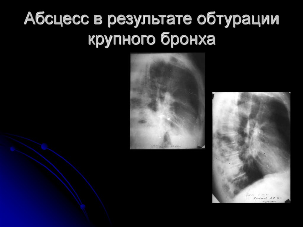 Абсцесс в результате обтурации крупного бронха