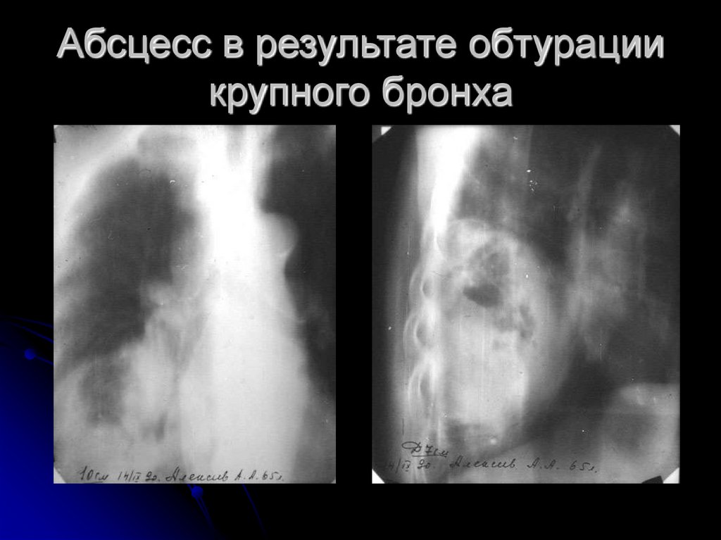 Абсцесс в результате обтурации крупного бронха