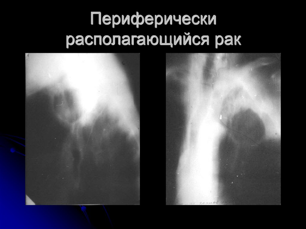 Периферически располагающийся рак