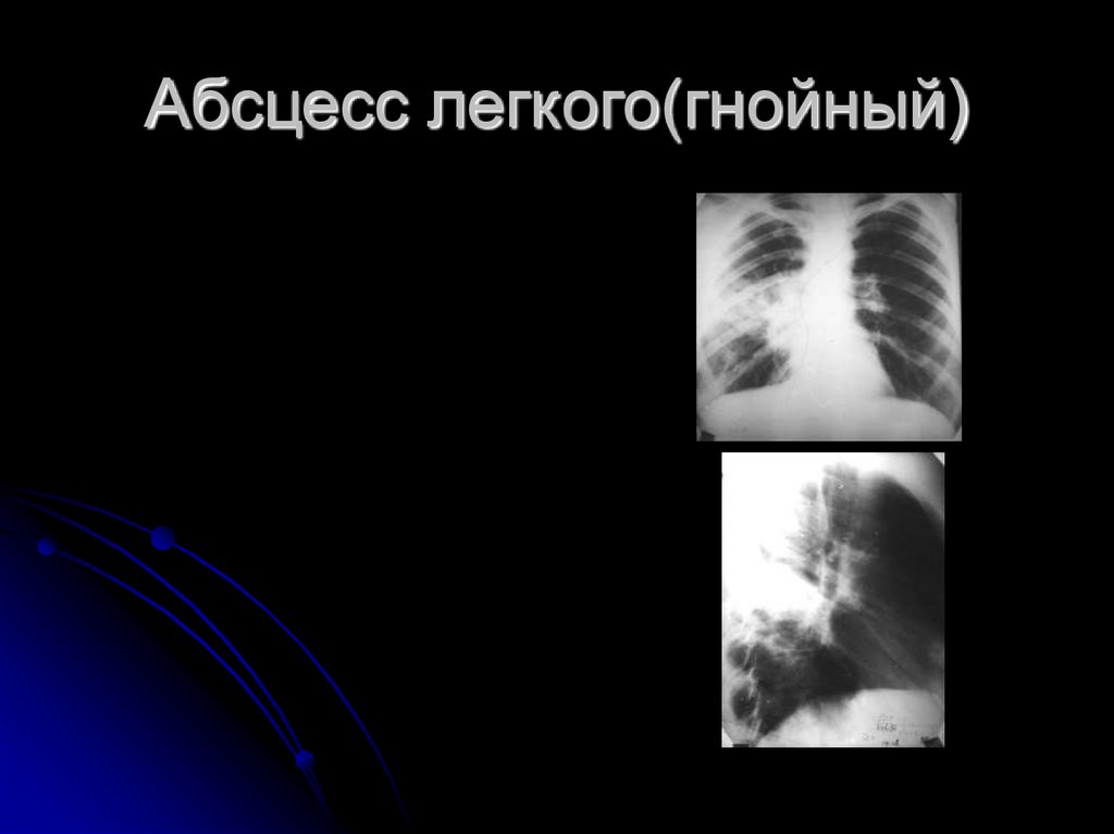 Абсцесс легкого(гнойный)