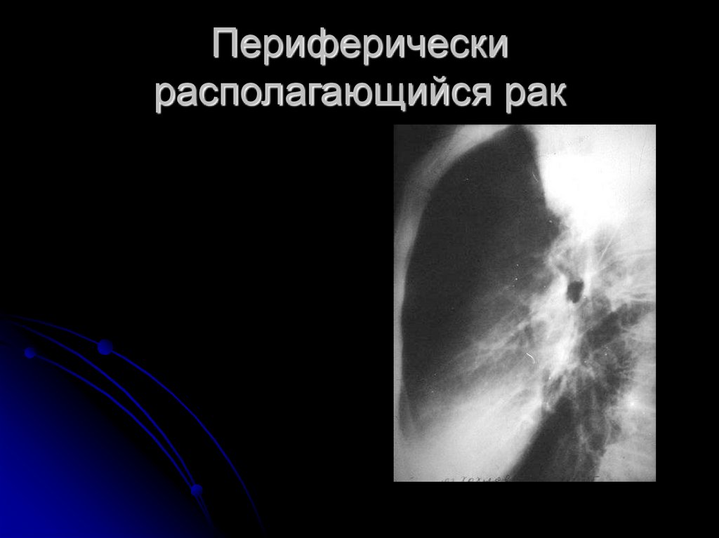 Периферически располагающийся рак
