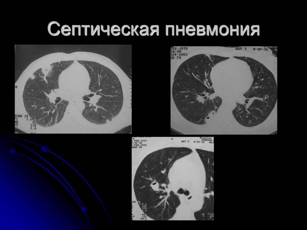 Кт картина пневмонии