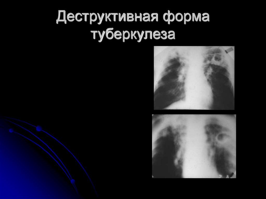 Деструктивная форма туберкулеза