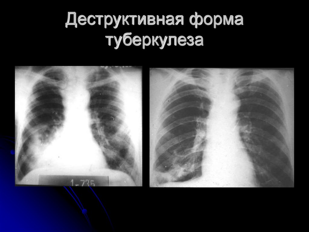 Закрытая форма. Деструктивный туберкулез. Деструктивные формы туберкулеза. Деструктивный туберкулез легких. Деструктивные формы туберкулеза легких.