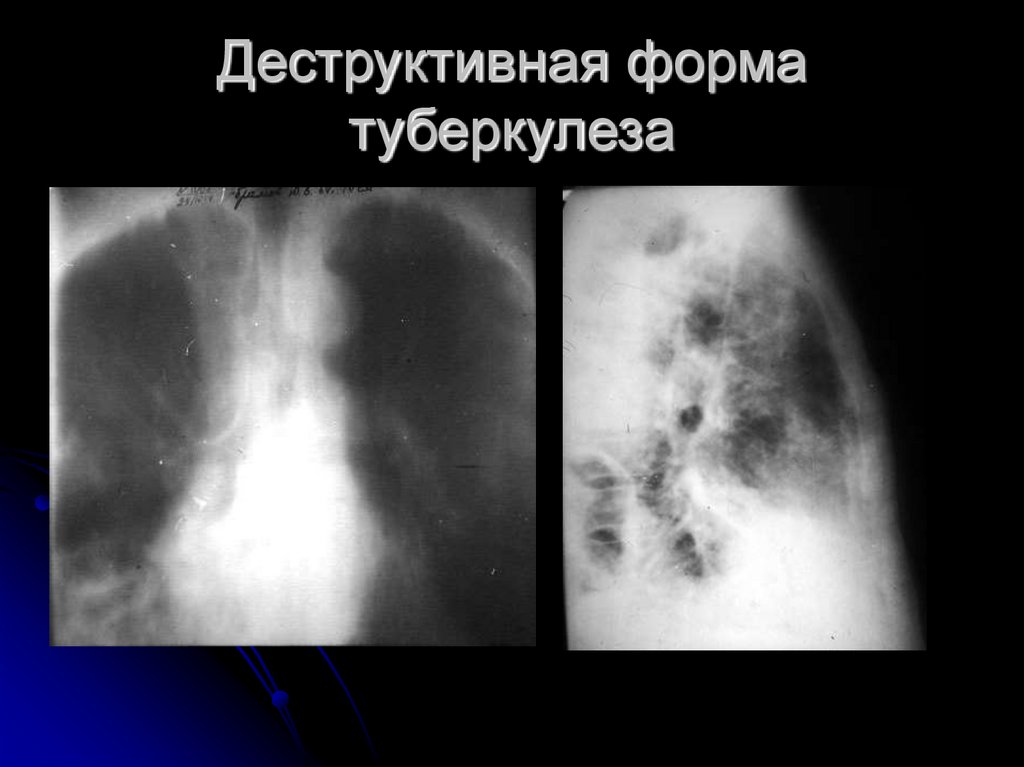 Деструктивная форма туберкулеза