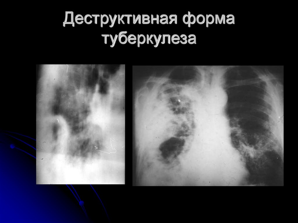 Деструктивные заболевания легких презентация