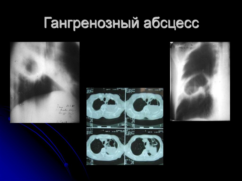 Гангренозный абсцесс