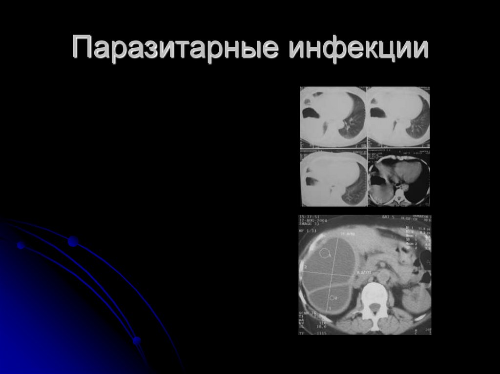Паразитарные инфекции