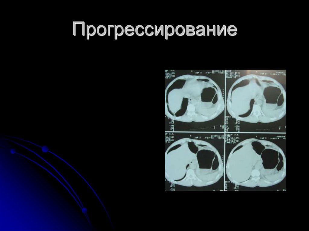 Прогрессирование