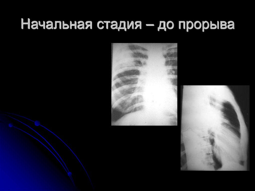 Начальная стадия – до прорыва