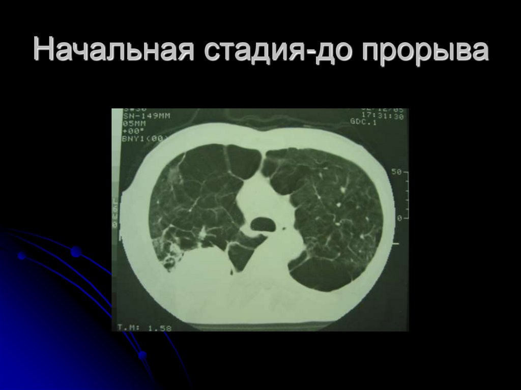 Начальная стадия-до прорыва