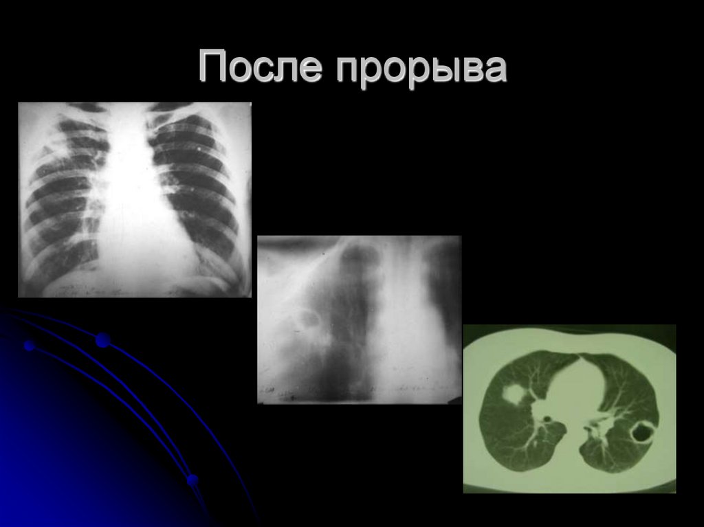 После прорыва